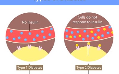 bệnh tiểu đường có 2 loại Tiểu đường type 1 và Tiểu đường type 2