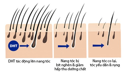 DHT- Nguyên nhân chính khiến nang tóc bị tổn thương và tóc dễ gãy rụng